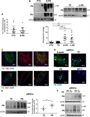 JMJD6 Dysfunction Due to Iron Deficiency in Preeclampsia Disrupts Fibronectin Homeostasis Resulting in Diminished Trophoblast Migration